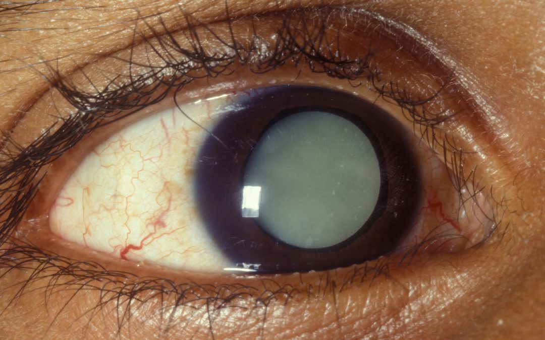 Cataract case mix study
