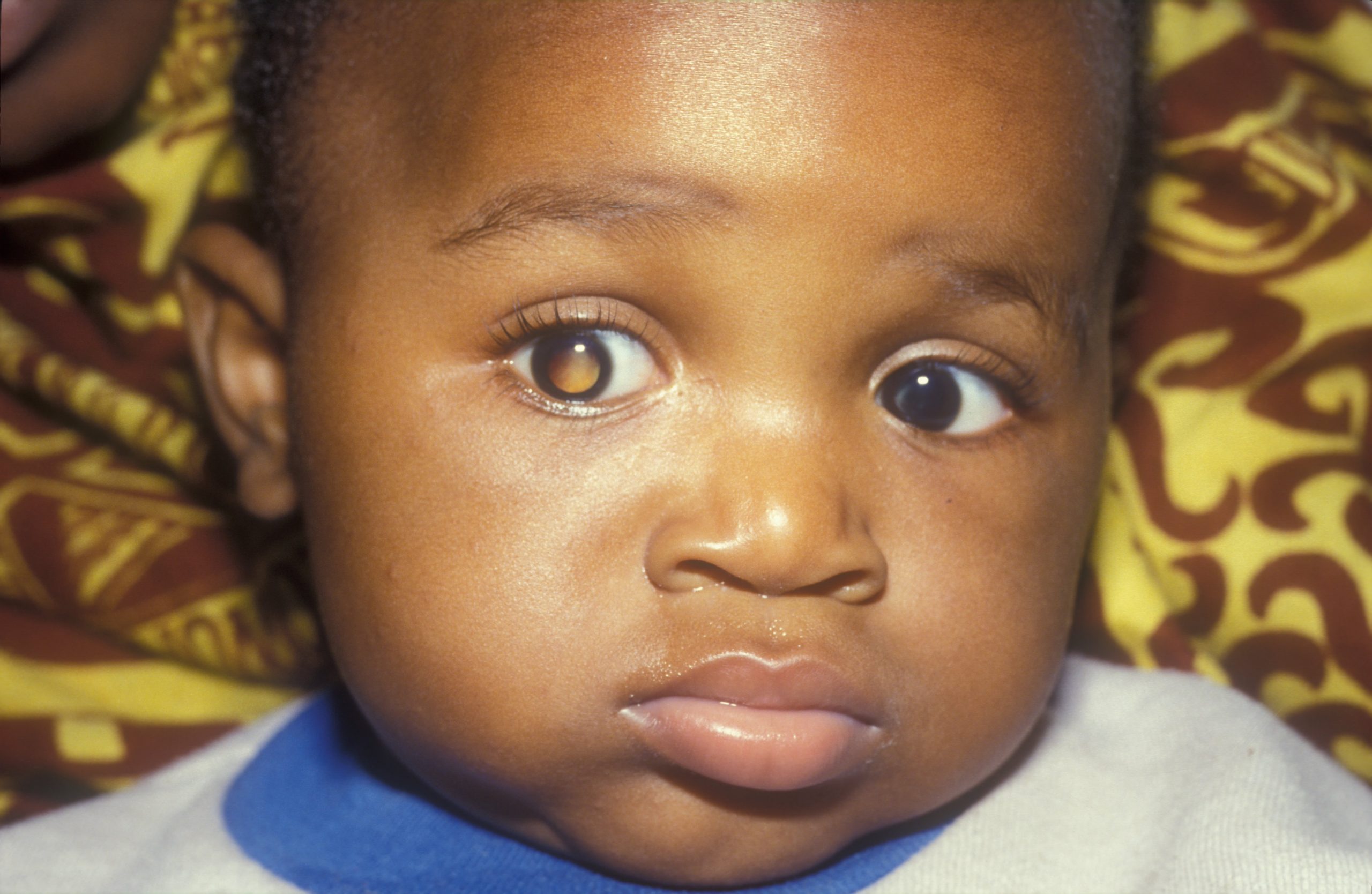 A baby with visible retinoblastoma in a light reflection looks at the camera
