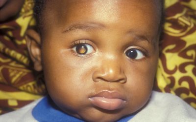 Children in low-income countries 16 times more likely to die from most common eye cancer
