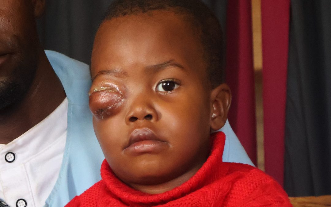 Nearly a quarter of children diagnosed with rare eye cancer in Africa die within one year