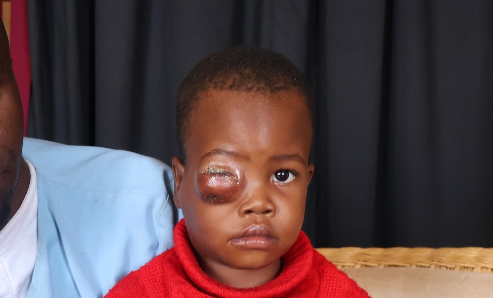 a child with suspected retinoblastoma has a large, swollen eye 