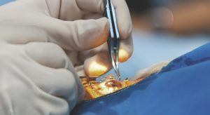a surgeon's hand places a lens above an eye in a surgical theatre