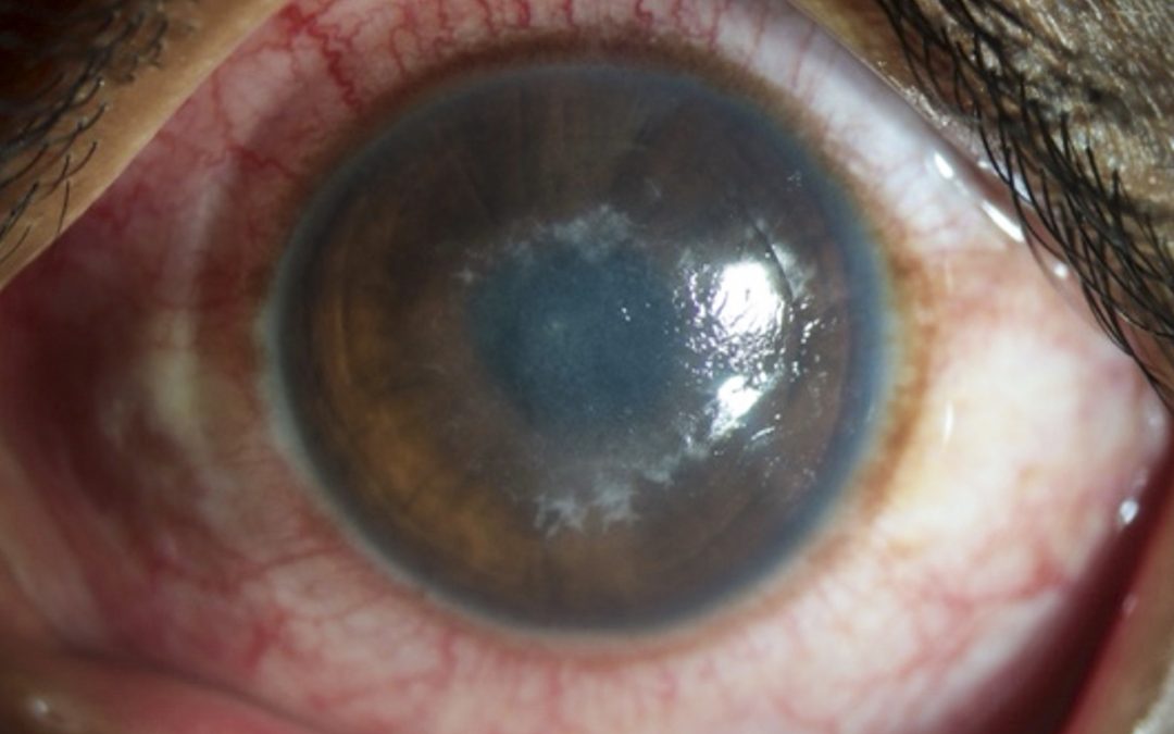 Global review finds important regional differences in antibiotic resistance in bacterial keratitis